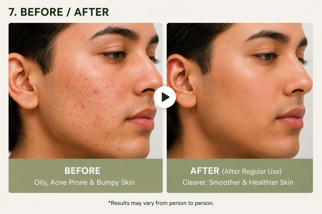 Acne Organic Soap